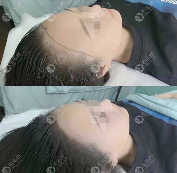 女士发际线种植一个月效果图