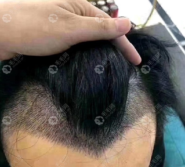 m发际线植发案例揭m发际线植发需要多大面积种植多少单位