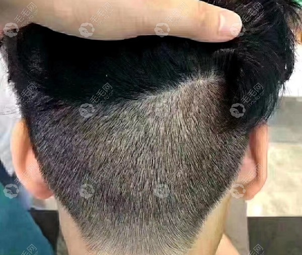 后枕部取发区效果图通过上文首张图片发友大概能感受到m型发际线植发