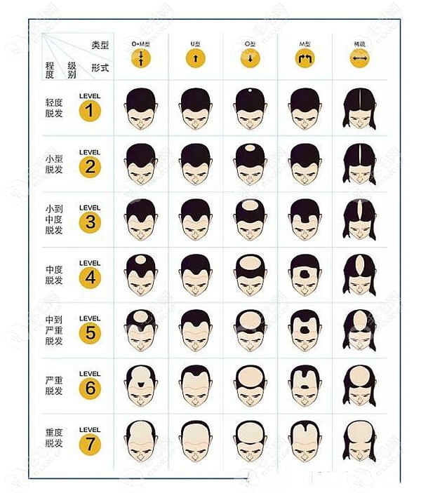 收藏植发数量种植指南