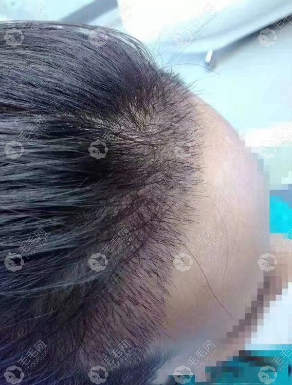 广州荔医毛发种植研究院尚俊主任种植发际线的效果是这样!