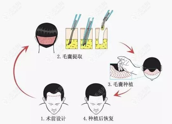 毛囊移植技术详细过程图