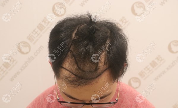 深圳新生毛发医院把我害惨了!花5万多做头顶加密形象都改了