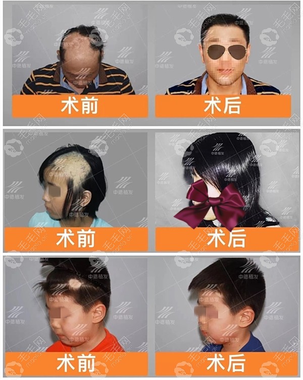 一块小疤痕植发大概要多少钱疤痕种植的成活率是多少