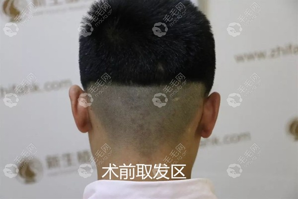 男士眉毛种植术前取发区 男士眉毛种植术前取发区