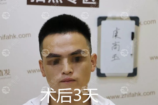 眉毛种植术后3天效果图 眉毛种植术后3天效果图