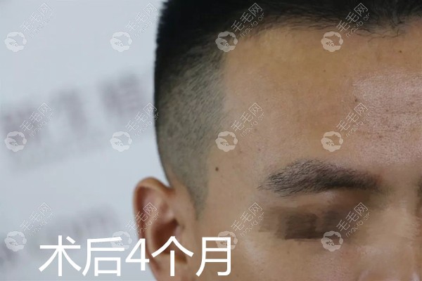 男士眉毛种植术后4个月效果 男士眉毛种植术后4个月效果