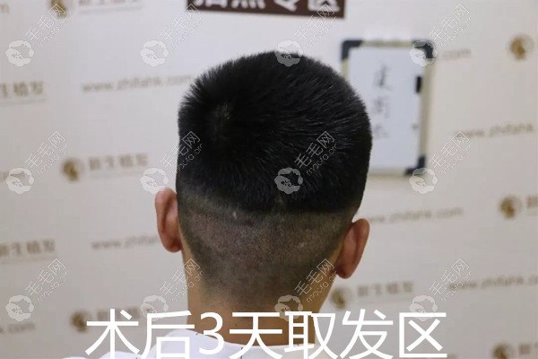 男士眉毛种植术后3天取发区 男士眉毛种植术后3天取发区