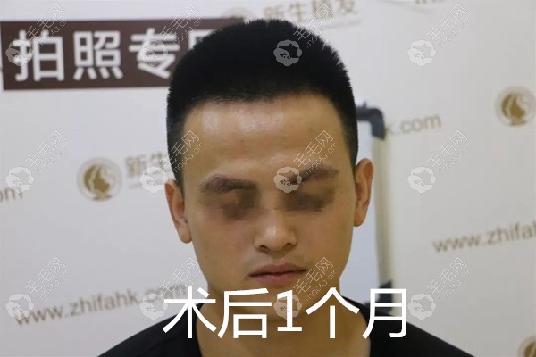 眉毛种植术后1个月效果 眉毛种植术后1个月效果