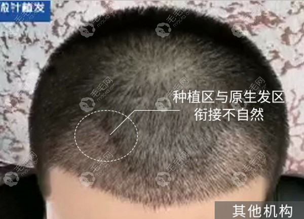 聊下成都恒美植发医院绒毛发际线种植1000单位的效果吧!