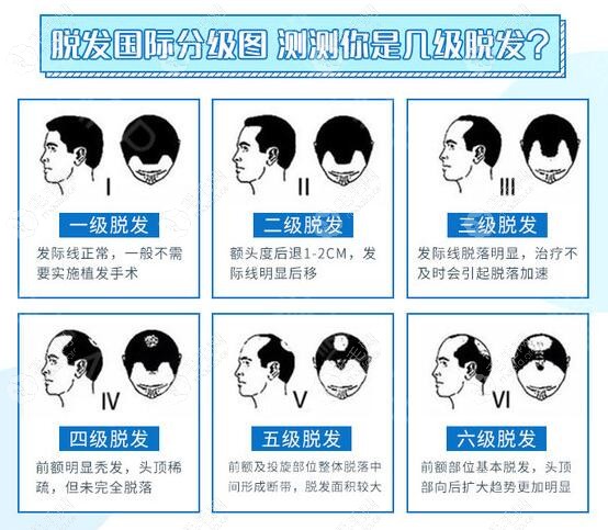 22岁男孩m型发际线和额角向后退两厘米,算是二级脱发.