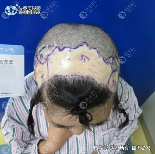 南京碧莲盛植发的靠谱性从SHT微针疤痕植发的效果中体现