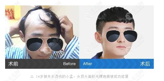 疤痕大面积修复在广州碧莲盛移植的毛囊