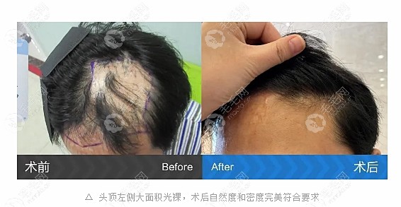 小面积烧伤在广州碧莲盛种植一次疤痕植发后的样子