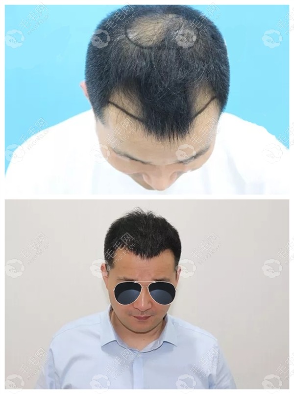 在北京碧莲盛做头顶稀疏加密种植发际线4150毛囊的效果真赞