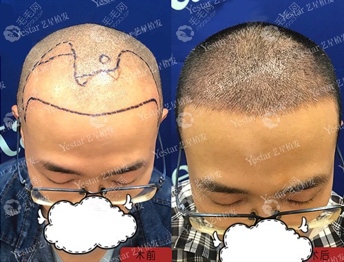 杭州哪家毛发专科医院的植发医生经验丰富技术好