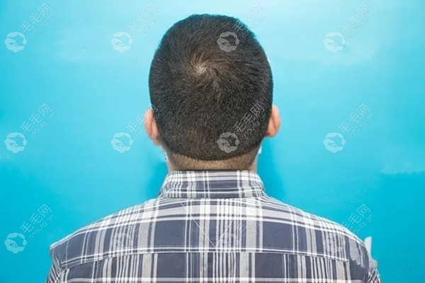 后枕部提取完毛囊地方还长头发吗植发3000毛囊会明显稀疏吗