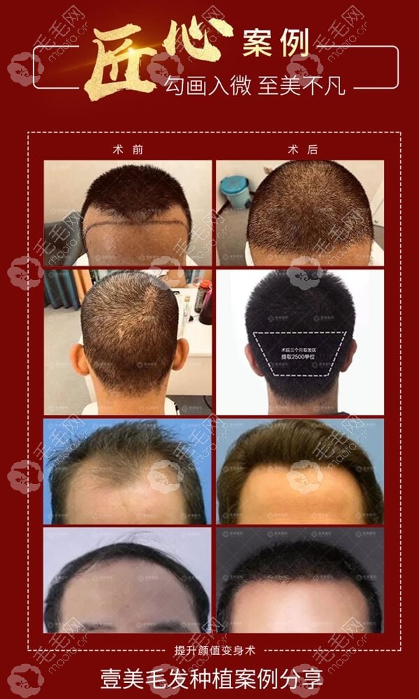 因发际线太高做了前额植发:请看40岁男人种植头发后的效果