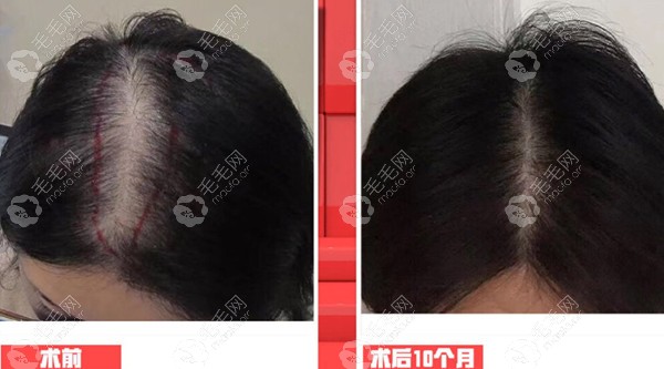 武汉同济医院女性发缝加密效果图