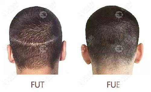 FUT植发技术和FUE植发技术取发后后枕部对比图