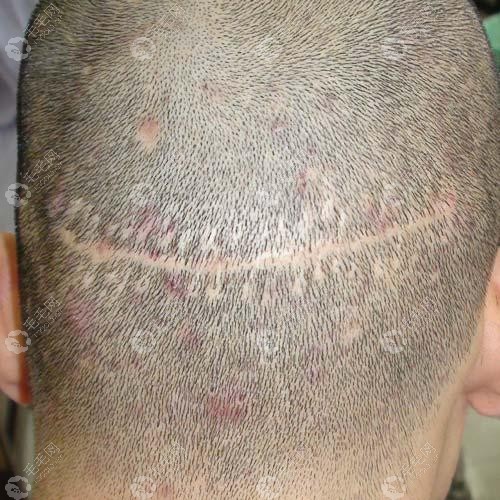 Fut植发后脑勺疤痕照片