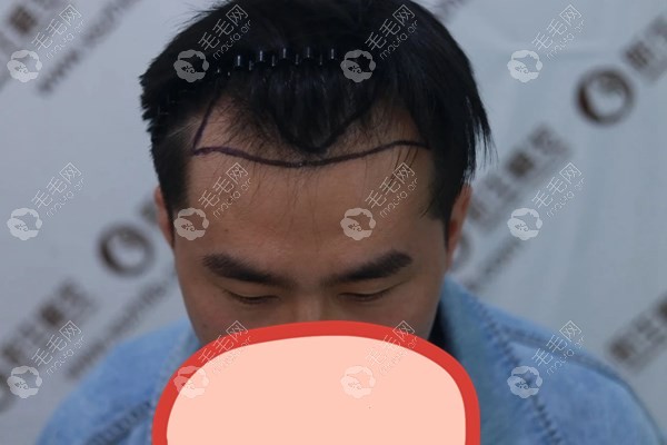 扬州新生毛发医院3d植发额角1200单位的效果图来喽！