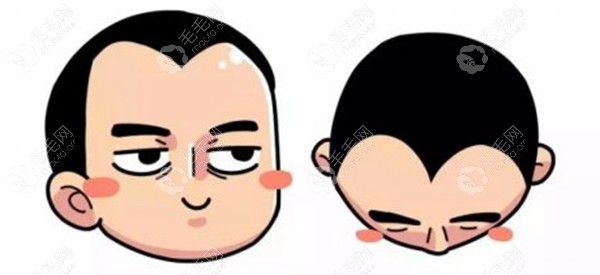 男士双额角植发六个月效果图!案例来源于怀化韩美植发医院