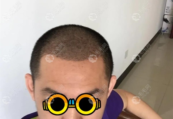 男性头顶稀疏加密种植2500毛囊单位的真实植发案例效果图这是刚刚做完