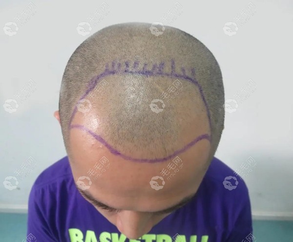 广州积美植发医院:男性头顶稀疏加密植发2500毛囊的真实案例