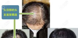 溢脂性脱发植发效果可以维持多久呢?植发后还用吃药维持吗?