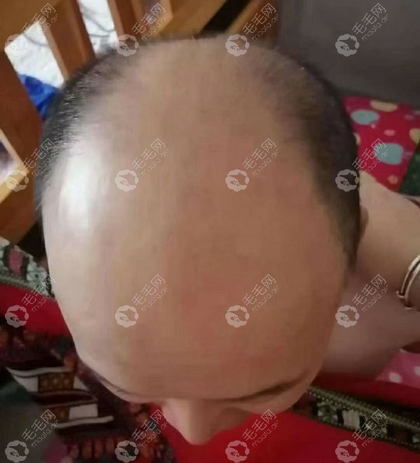 术前已形成大面积脱发