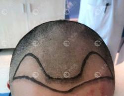 真实植发案例分享:男性额角植发2000毛囊3个月的前后对比图