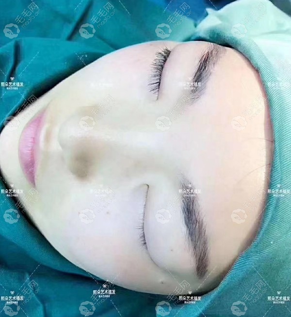 那今天就来深挖下济南熙朵做睫毛移植效果如何?
