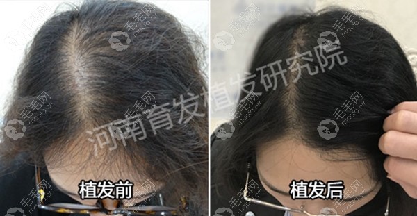 女士发缝加密种植案例