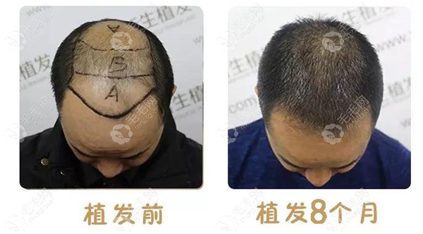 武汉新生7级脱发植发4500单位效果,当时医生种头发种7个小时