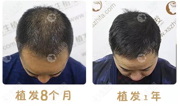 武汉新生7级脱发植发4500单位效果当时医生种头发种7个小时