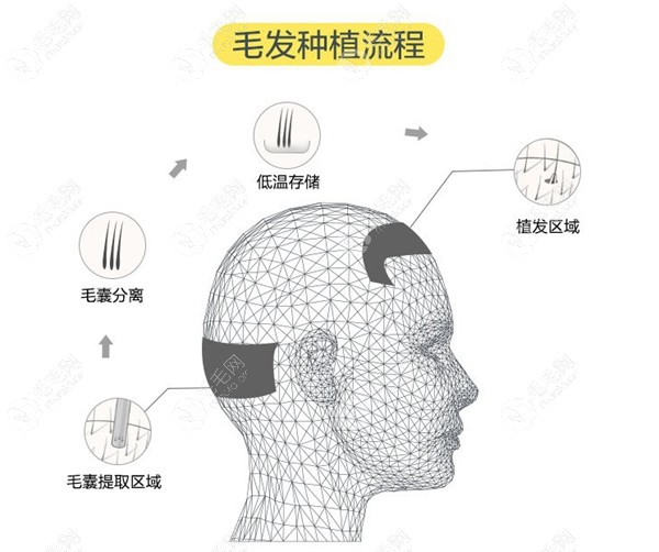 王涛植发手术过程图