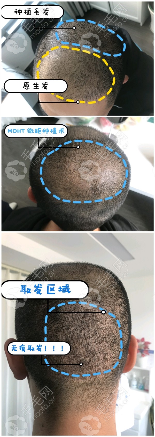 北京联合丰联丽格的男性头顶加密植发手术案例