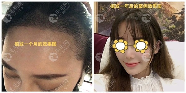 这有北京丰联丽格的真实植发手术案例效果图片大集合,速进