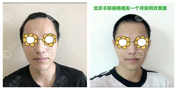 北京丰联丽格男性发际线植发手术真实案例