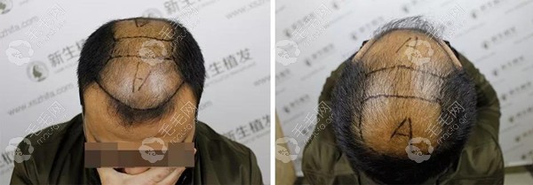 33岁头顶全秃后植发6000个单位的效果,选的是杭州新生tddp技术