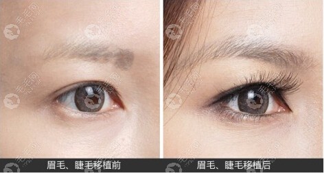 广州荔医植发哪个医生种眉毛效果好？