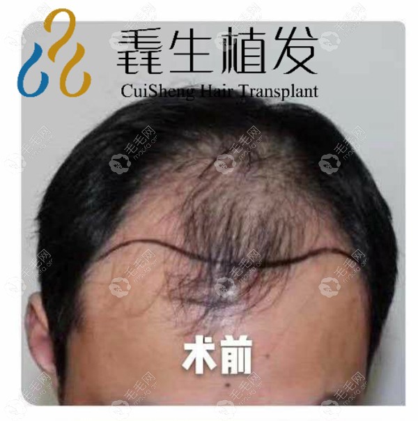 福州毳生植发的发际线种植恢复期图片,猜我多久看到效果?