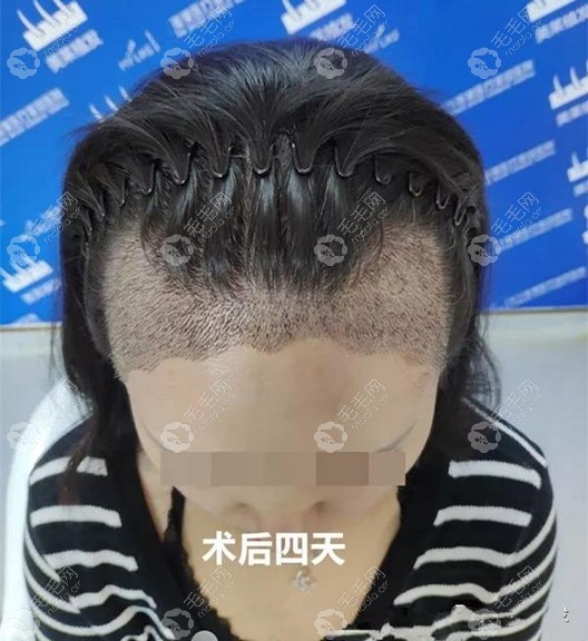 秀下我的波浪形发际线种植恢复成活图片,现已"际"胜一筹_衡阳美莱植发