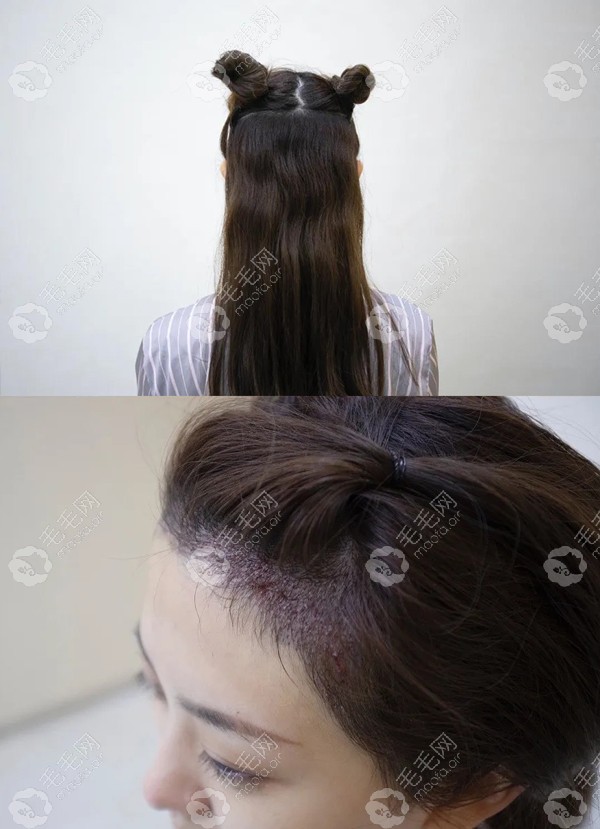 杭州首瑞不剃发植发种植发际线的效果展示