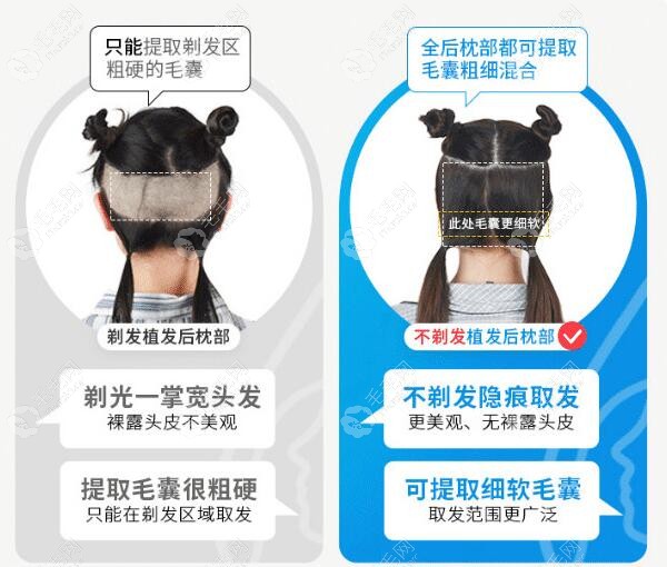 杭州首瑞不剃发植发技术优势