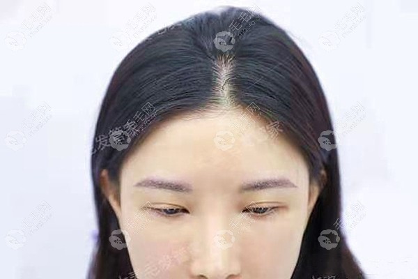 广州大麦微针种植眉毛一个星期的效果