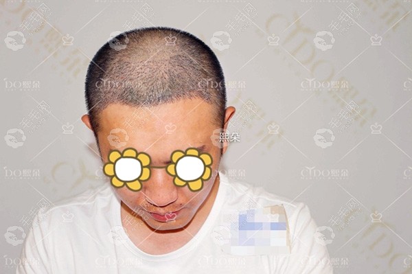 找张连荣种植男士额角发际线2500单位的案例_承德熙朵植发发际线案例