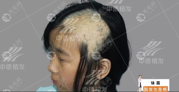 小孩子头皮烫伤能植发吗