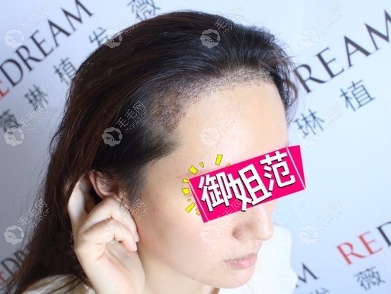 在杭州薇琳种植发际线第四天的效果图